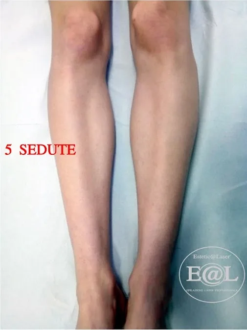 Gambe dopo il percorso laser