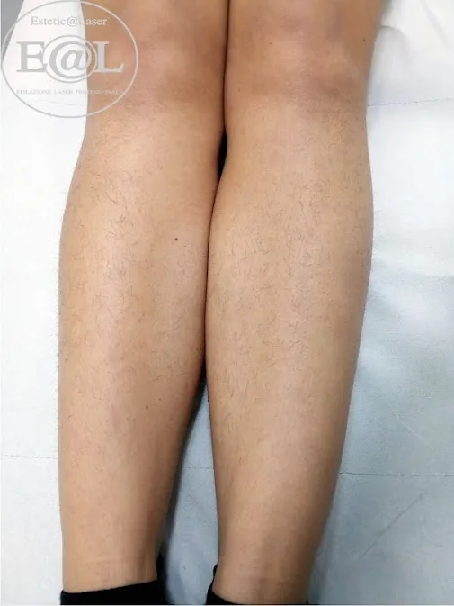 Gambe prima del percorso laser