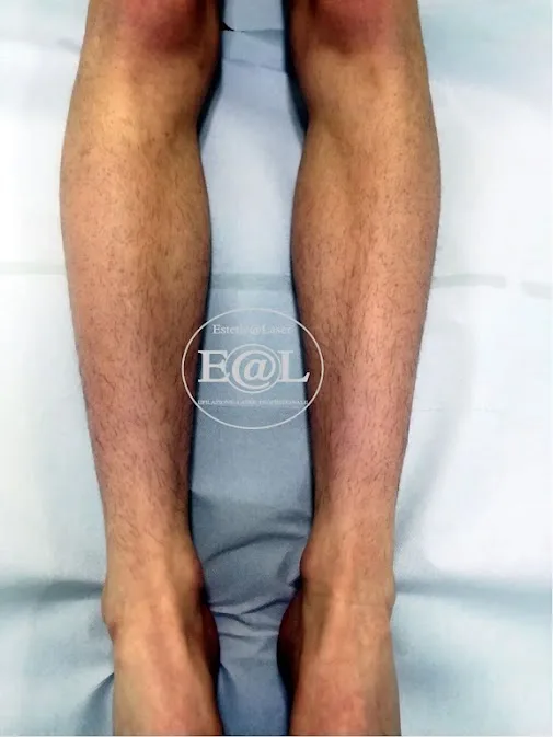 Gambe prima del percorso laser